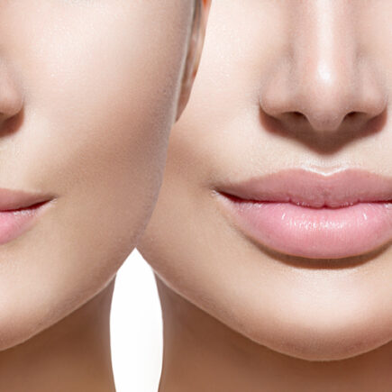 Lip Fillers