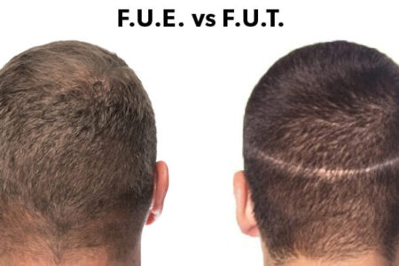 FUE vs. FUT Which Is the Better Hair Transplant Method